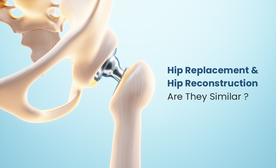 Are hip reconstruction and hip replacement similar?